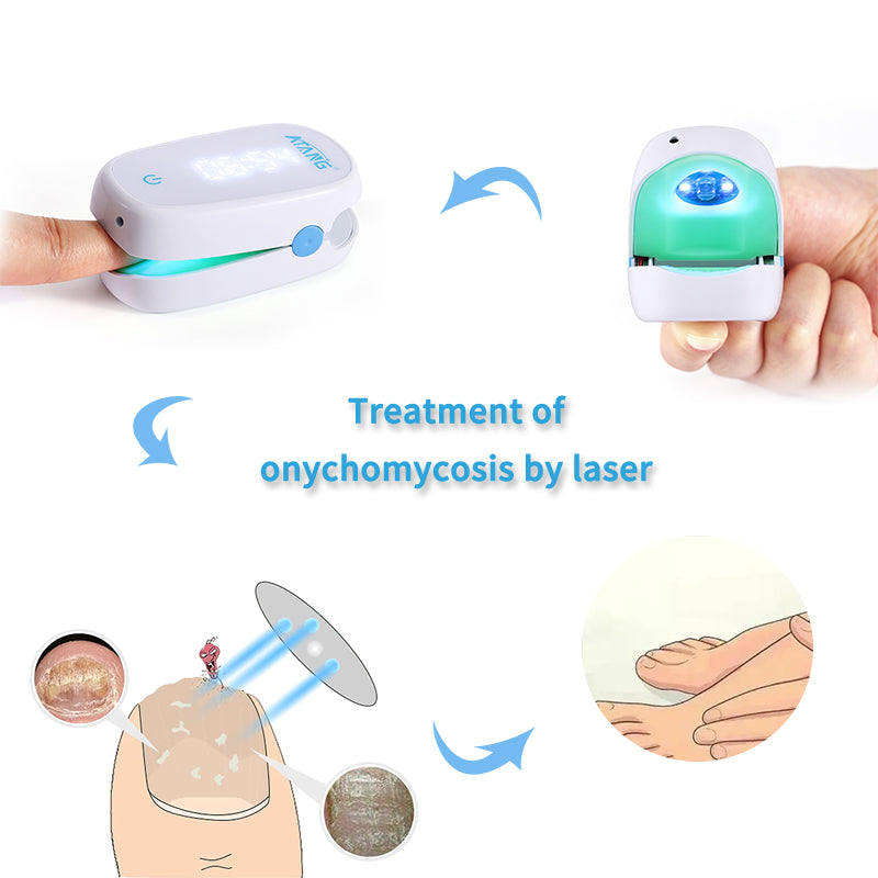 Toenail Fungus Laser Therapy Device for Onychomycosis and Nail Fungal Laser Device